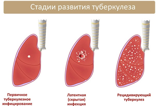 Банки на спину. Польза и вред при кашле, остеохондрозе, грыже позвоночника, как ставить