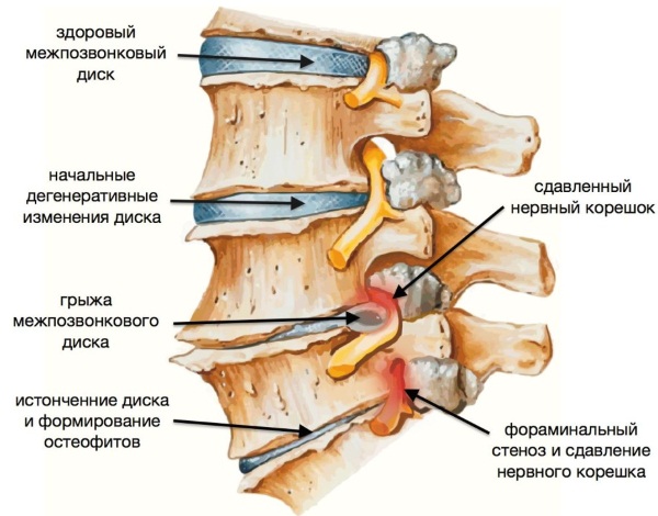 Банки на спину. Польза и вред при кашле, остеохондрозе, грыже позвоночника, как ставить