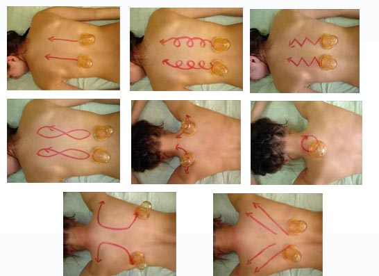 Банки на спину. Польза и вред при кашле, остеохондрозе, грыже позвоночника, как ставить