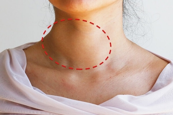 Узловой зоб