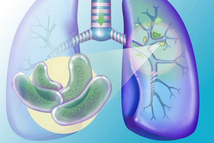 Туберкулез