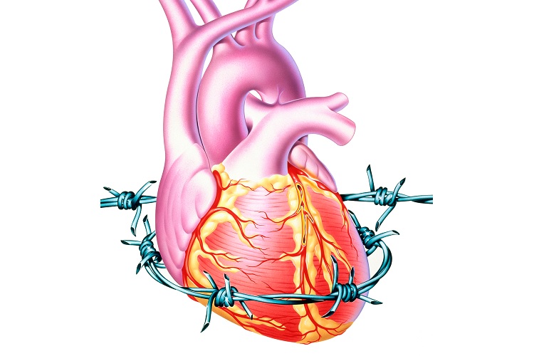 Стенокардия