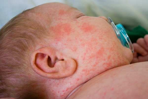 У малыша корь