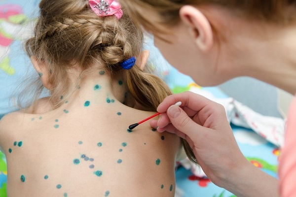 Обработка кожи при ветрянке