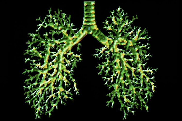 Бронхоэктазы