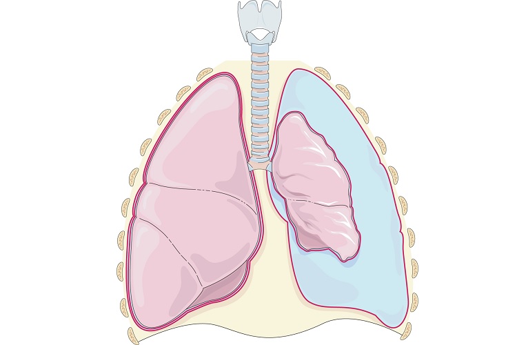 Пневмоторакс