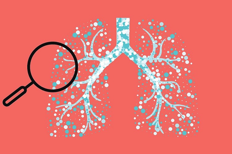 Общие признаки ИЗЛ