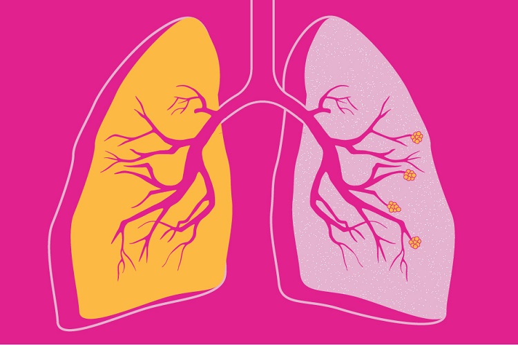 Визуализация ХОБЛ