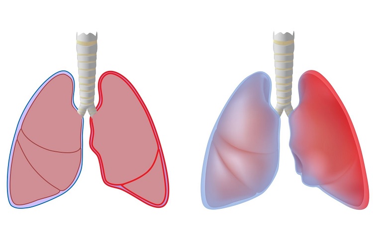 Развитие плеврита легких