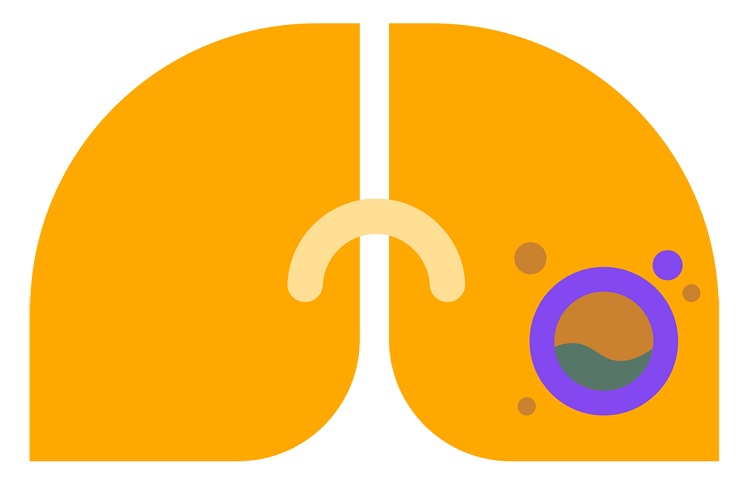 Как визуально выглядит абсцесс легкого