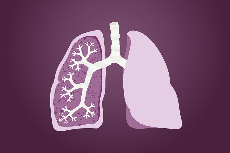 Запыленное легкое