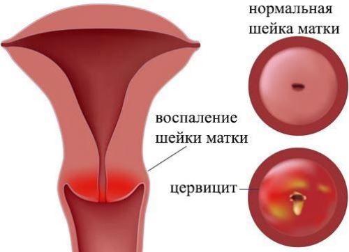 Что такое цервицит шейки матки Цервицит шейки матки