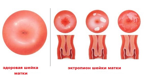 Что такое эктропион шейки матки Эктропион шейки матки
