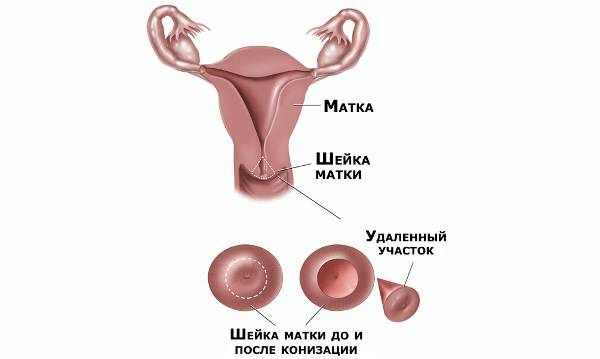 Проведение конизации шейки матки Конизация шейки матки