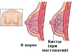 месячные во время мастопатии