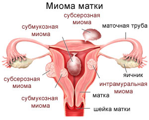 месячные при миоме матки